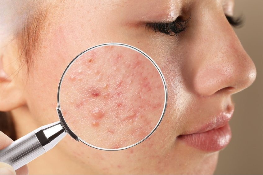 The Harmful Effects of Acne on Skin and Daily Life 💢