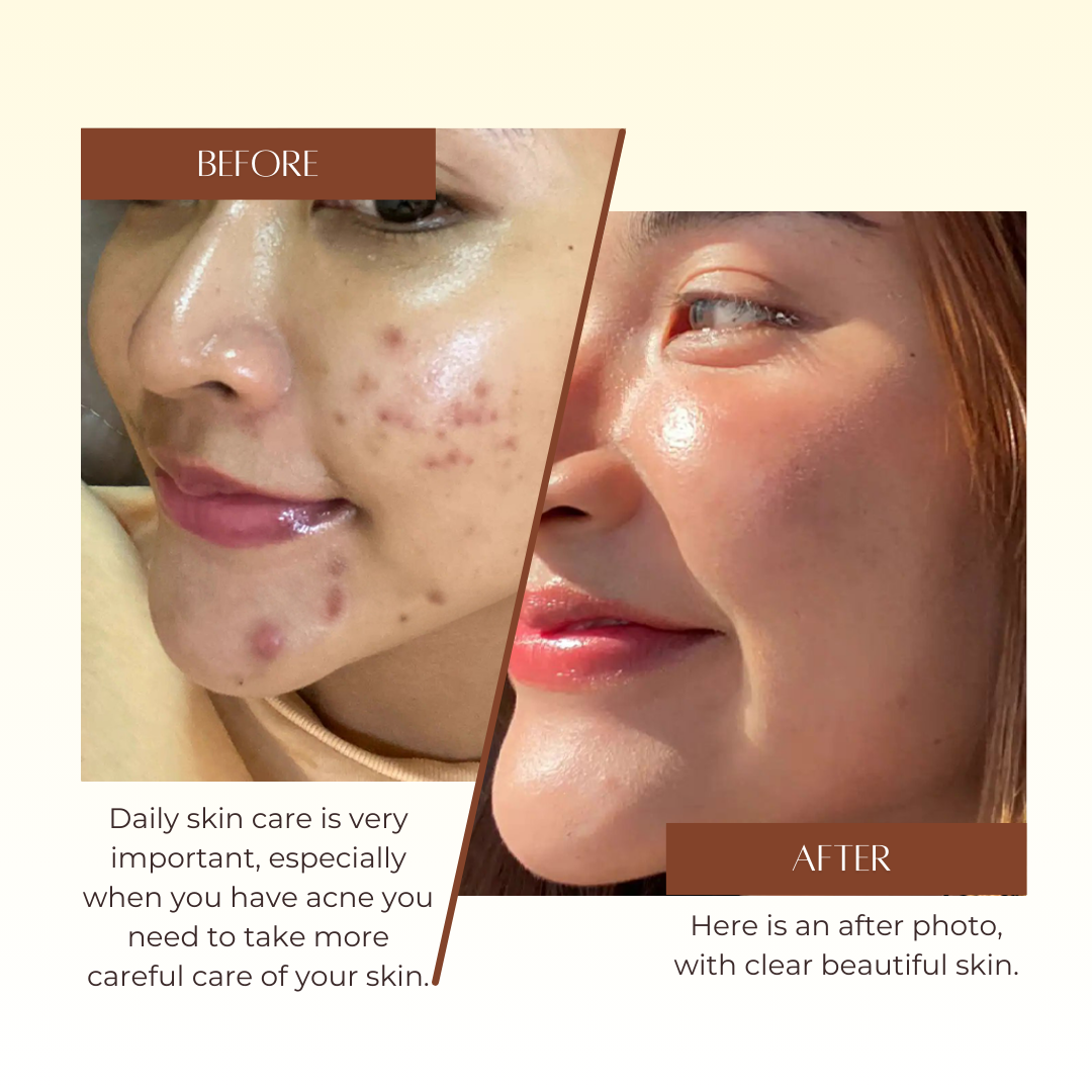 Acne Serum Ladeen 20ml