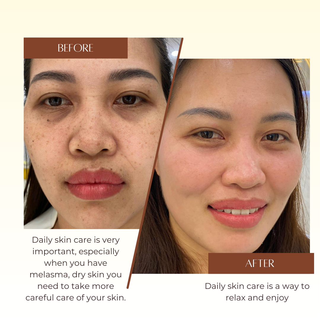 Melasma Serum Ladeen 20ml