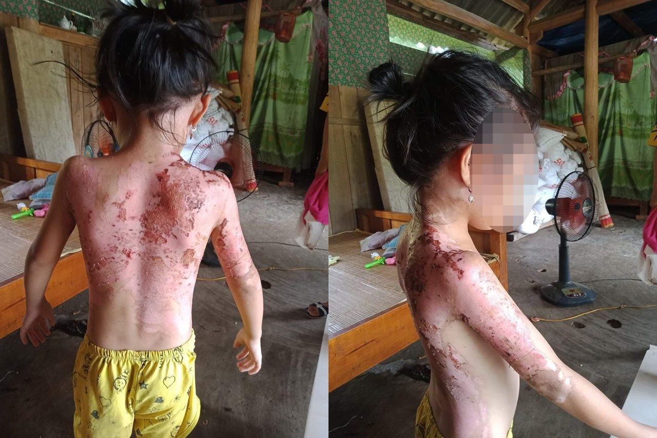 Nghi chồng ngoại tình với hàng xóm, tạt ca nước sôi vào 4 mẹ con