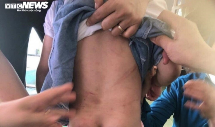 Tạm giữ dì ruột dùng chổi sắt đánh cháu gái 4 tuổi nhập viện