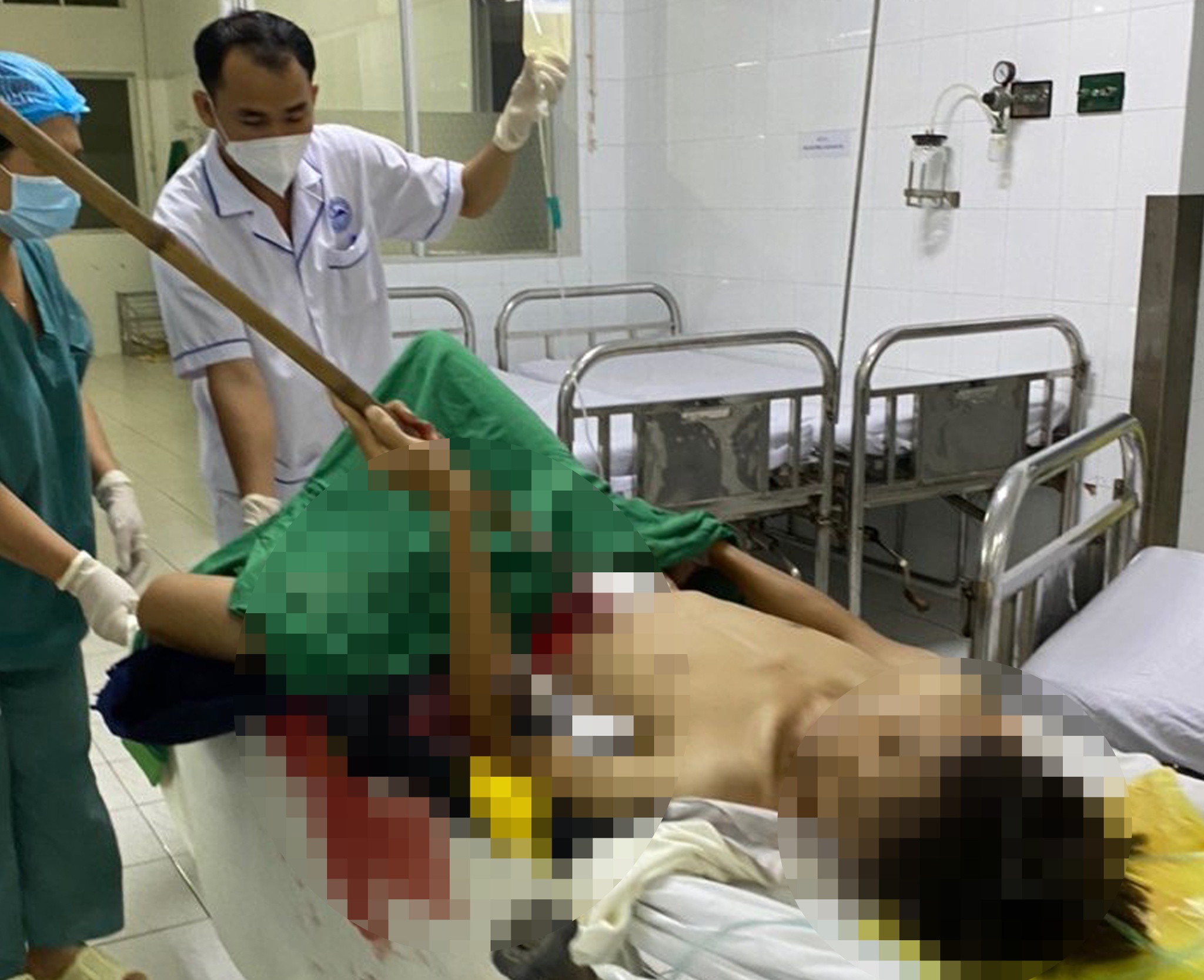 Cấp cứu nam thanh niên bị dao cạo mủ đâm thủng bụng