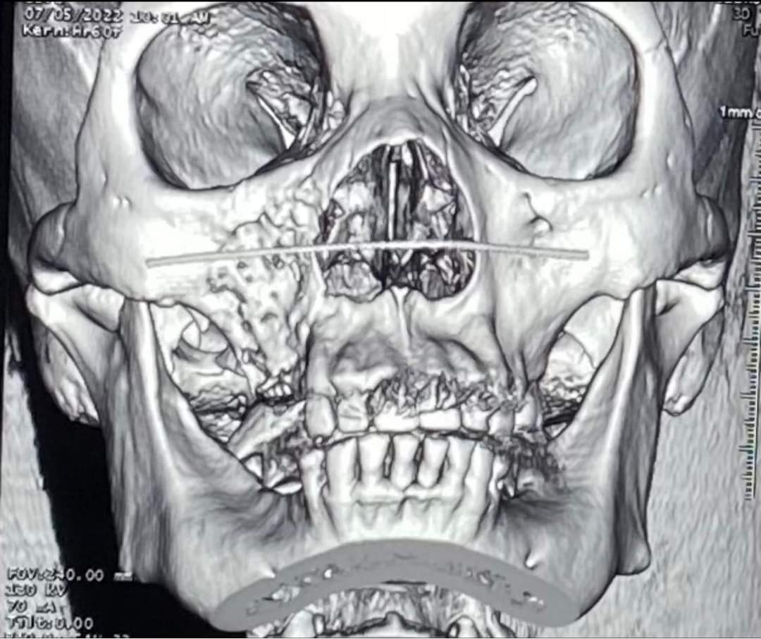 Hàng loạt ca bệnh hoại tử xương hàm trên: Sở Y tế TP.HCM vào cuộc