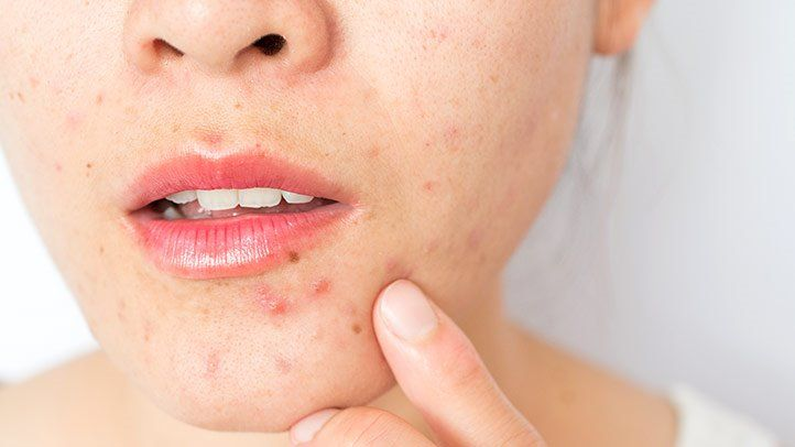 Ăn vặt có phải là nguyên nhân gây ra mụn trứng cá?