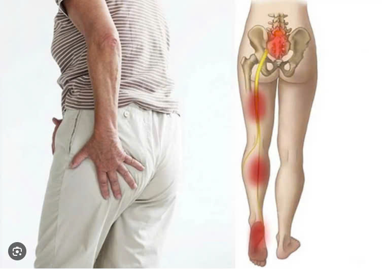 Chữa đau lưng, Đau dây thần kinh Toạ bằng điện sinh học DDS