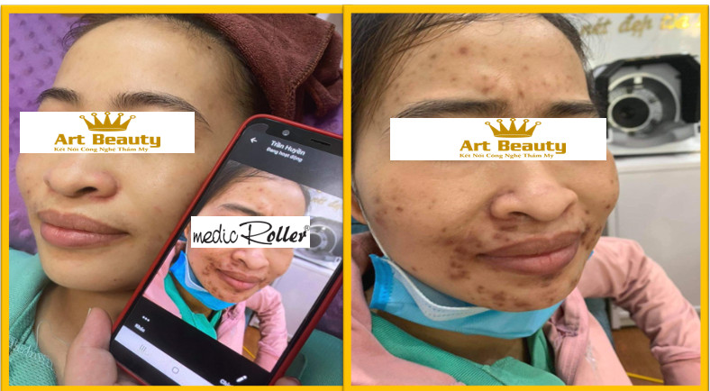 Điều trị thâm sau mụn thành công cho chị Hạnh tại Art Beauty