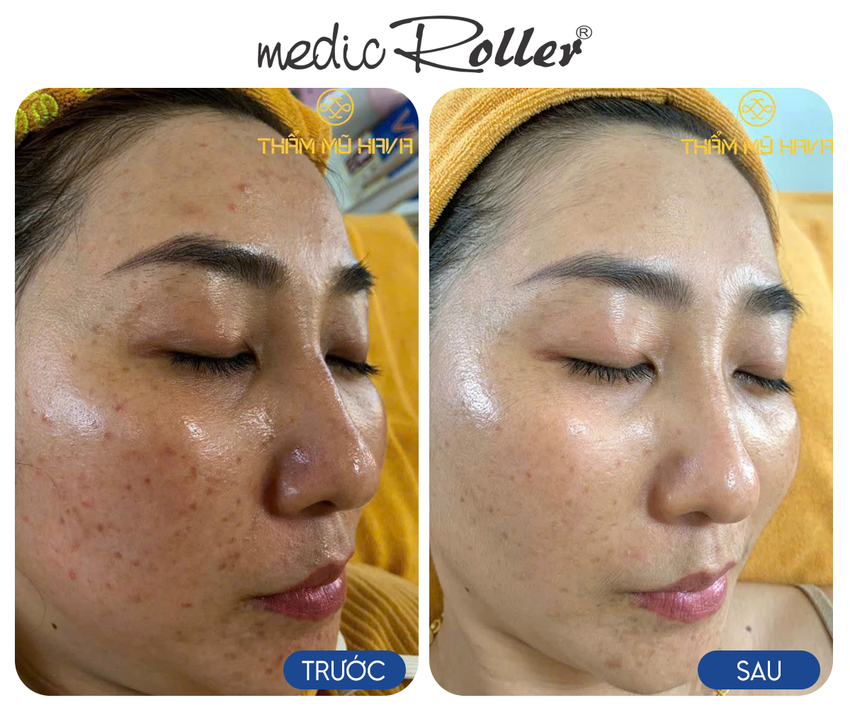 Giải cứu làn da nhiễm Corticoid: Bí quyết Detox hiệu quả từ Artbeauty