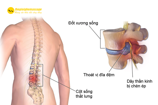 Tổng quan về thoát vị đĩa đệm