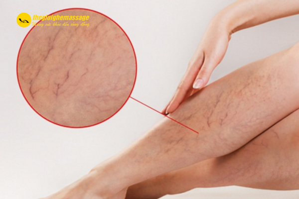 Khi nào KHÔNG nên dùng ghế massage nếu bị suy giãn tĩnh mạch?