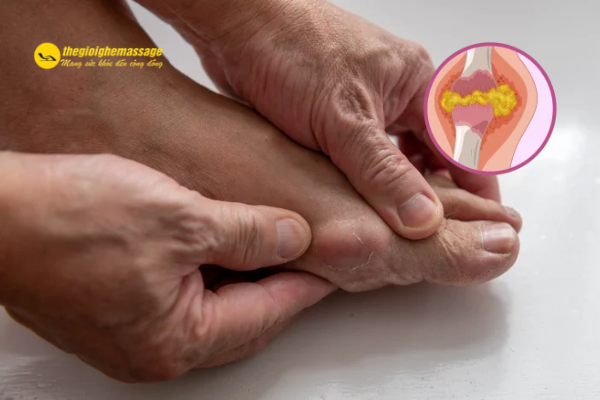 Bệnh gout là gì?