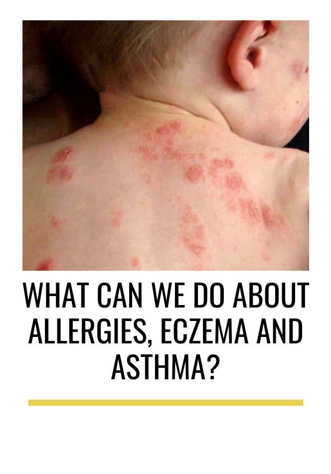 Dị ứng – hen – eczema: bộ ba liên quan gì đến nhau?