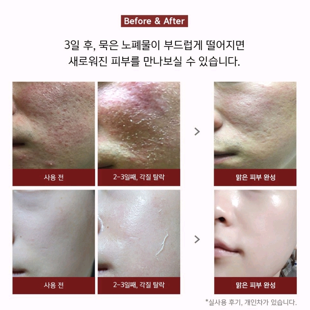 DERMA SKIN PEEL BQCELL - TÁI TẠO DA