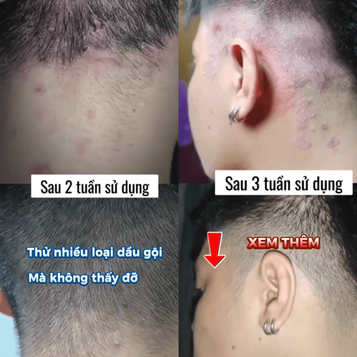Dầu Gội Canova Rivescal DS 200ml – Giảm Viêm Da Đầu, Nấm Gàu, Mụn Đỏ, Viêm Da Tiết Bã, Làm Dịu Da Đầu, Kiểm Soát Nhờn Hiệu Quả