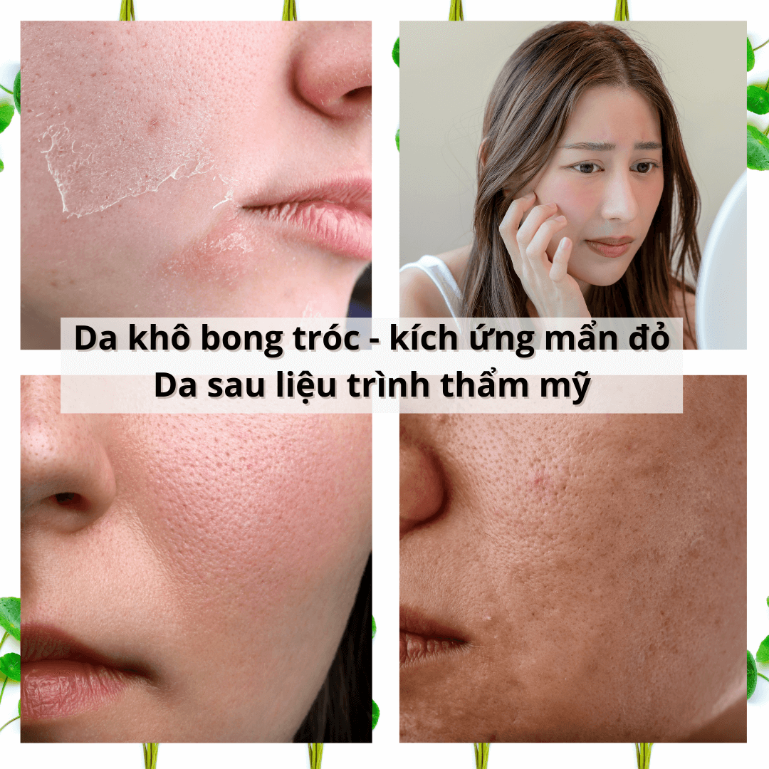 Kem dưỡng dịu da nhạy cảm CANOVA SENSIVEN P22 - SOOTHING CREAM dưỡng ẩm giảm kích ứng đỏ da