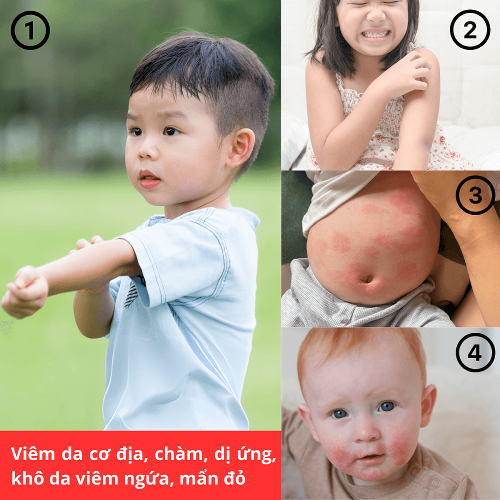 Nhũ tương bôi Latopic Probiotic Emollient Active Body Emulsion viêm da cơ địa chàm sữa, làm dịu da, giảm ngứa, giảm khô (250ml)