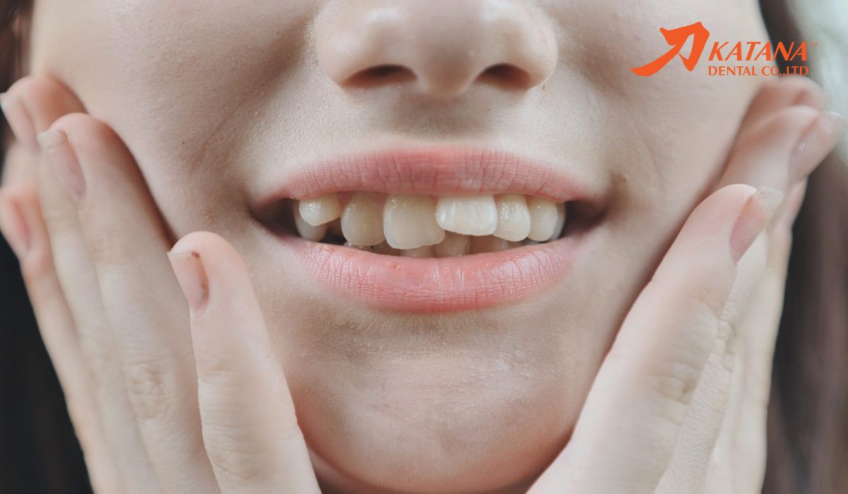 Răng cửa mọc lệch: Phân loại, nguyên nhân & cách khắc phục