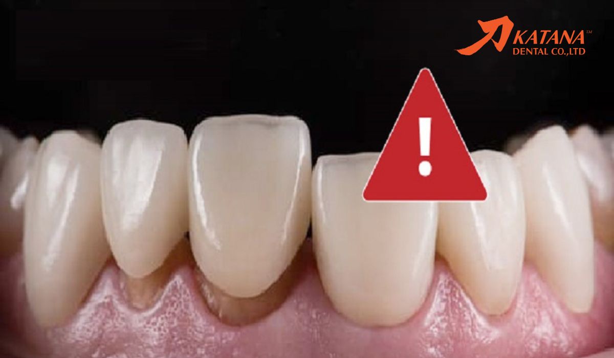 Răng sứ bị hở kẽ: Dấu hiệu, nguyên do & cách xử lý hiệu quả