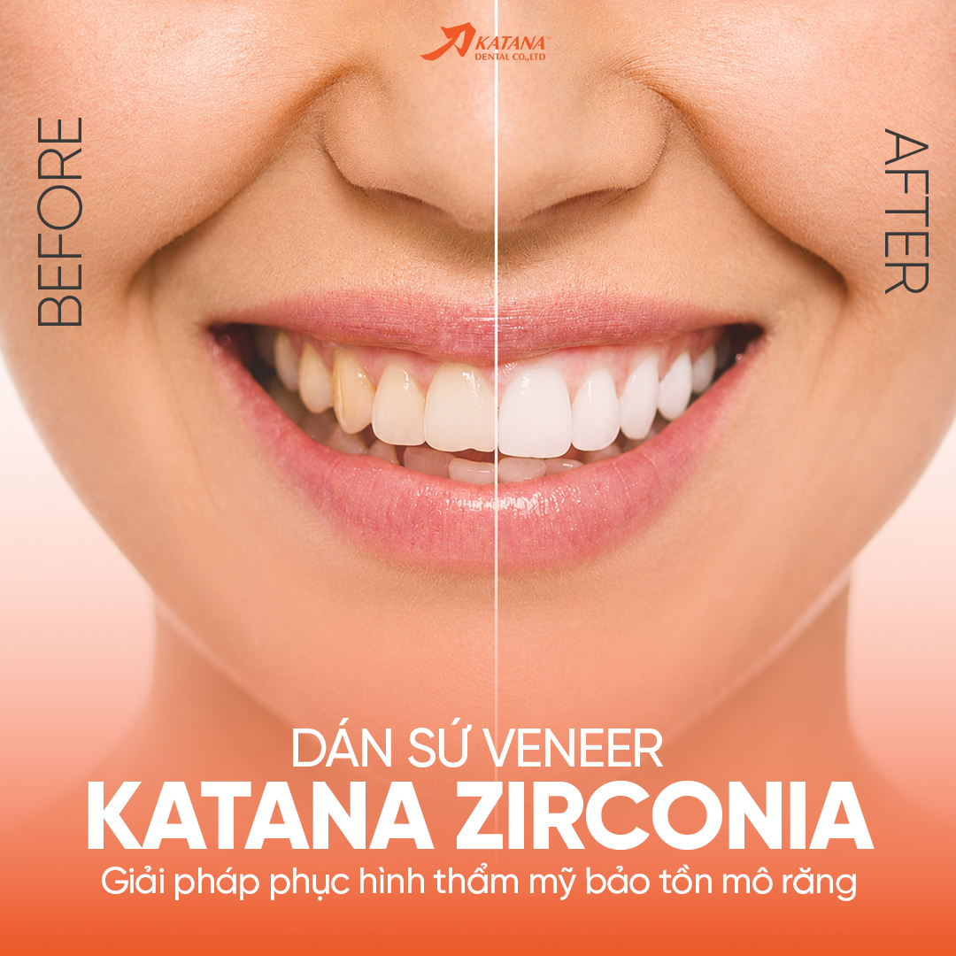 DÁN SỨ VENEER KATANA ZIRCONIA – GIẢI PHÁP PHỤC HÌNH THẨM MỸ BẢO TỒN MÔ RĂNG!