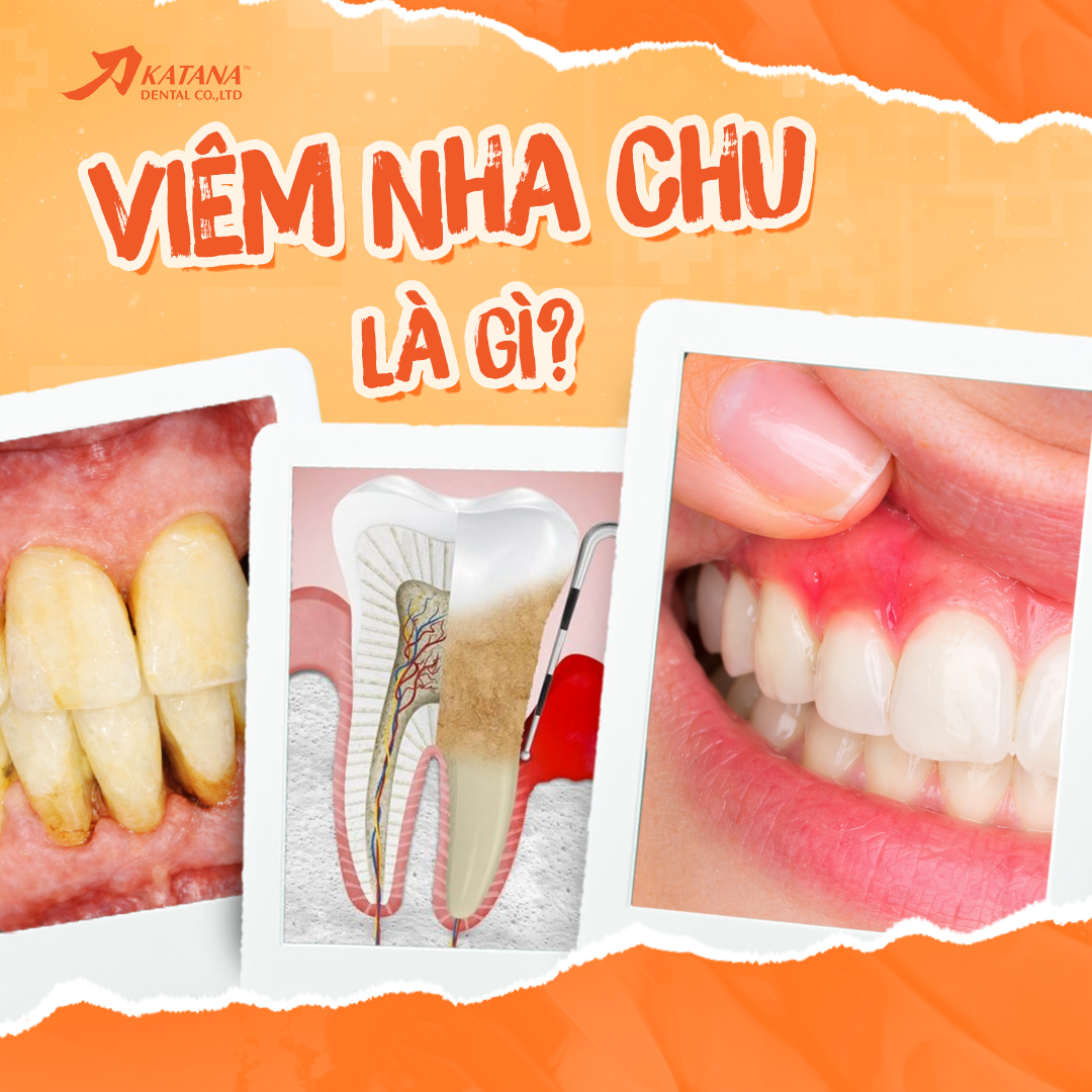 Viêm nha chu là gì? Dấu hiệu, nguyên nhân và cách điều trị