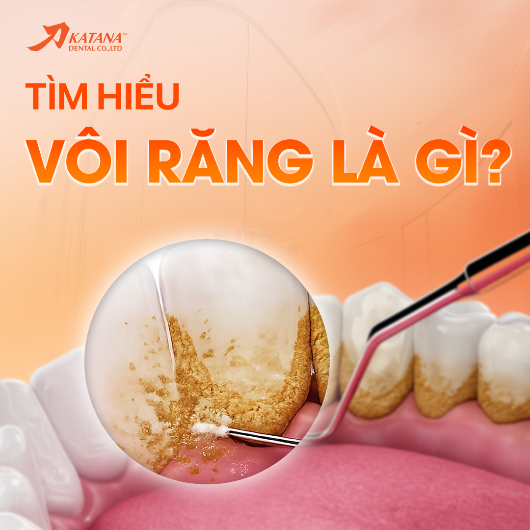 Vôi răng là gì? Các cấp độ và cách ngăn ngừa, xử lý vôi răng