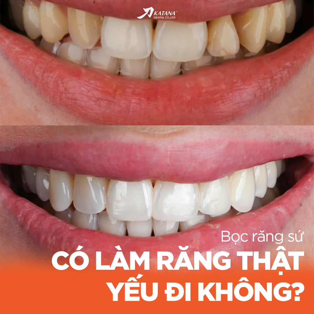 BỌC RĂNG SỨ CÓ LÀM RĂNG THẬT YẾU ĐI - SỰ THẬT KHÔNG PHẢI AI CŨNG BIẾT?