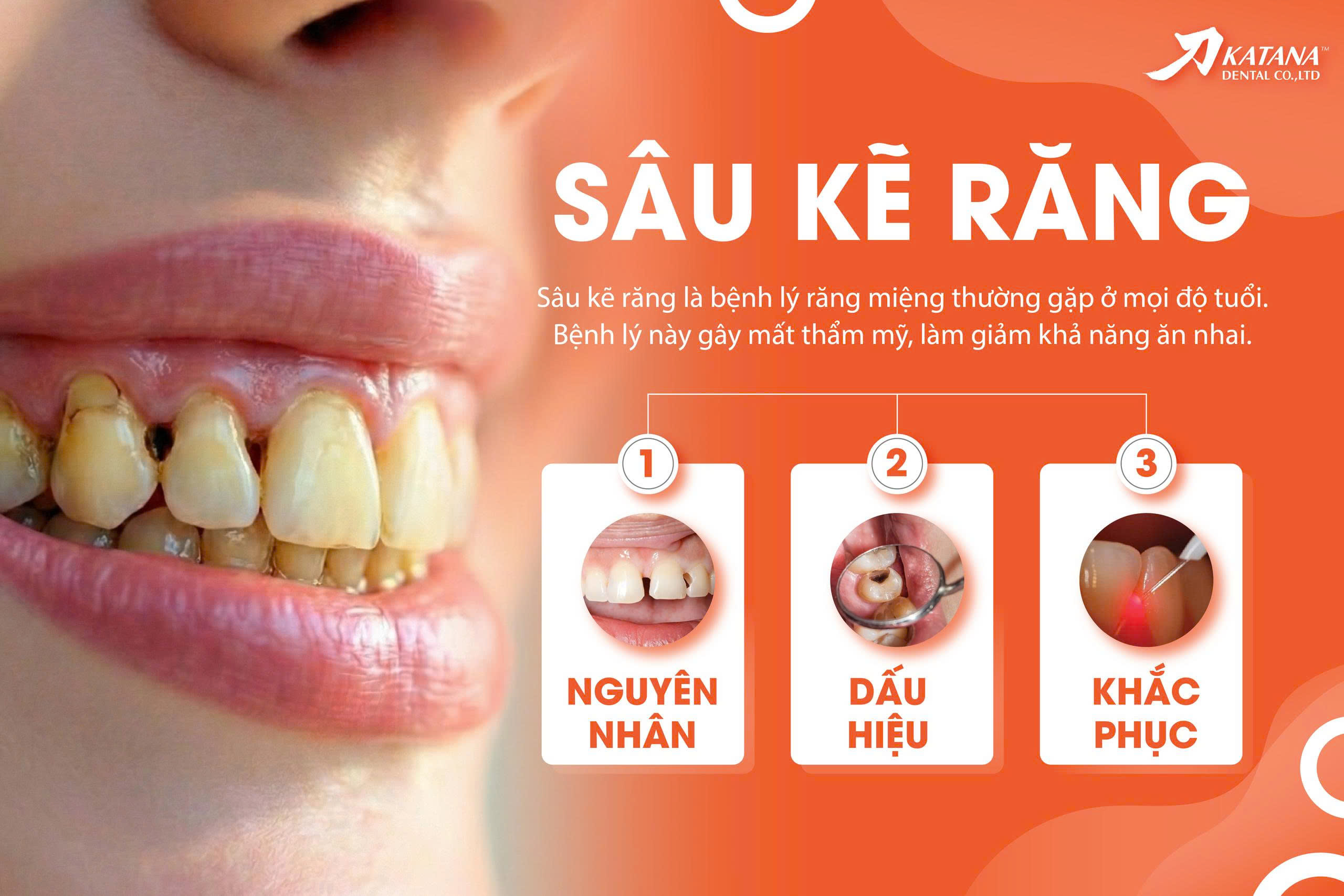Sâu răng kẽ là gì? Dấu hiệu, nguyên nhân và cách khắc phục