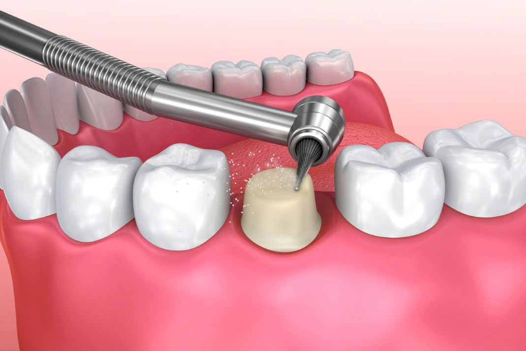 Làm răng sứ có đau không 1