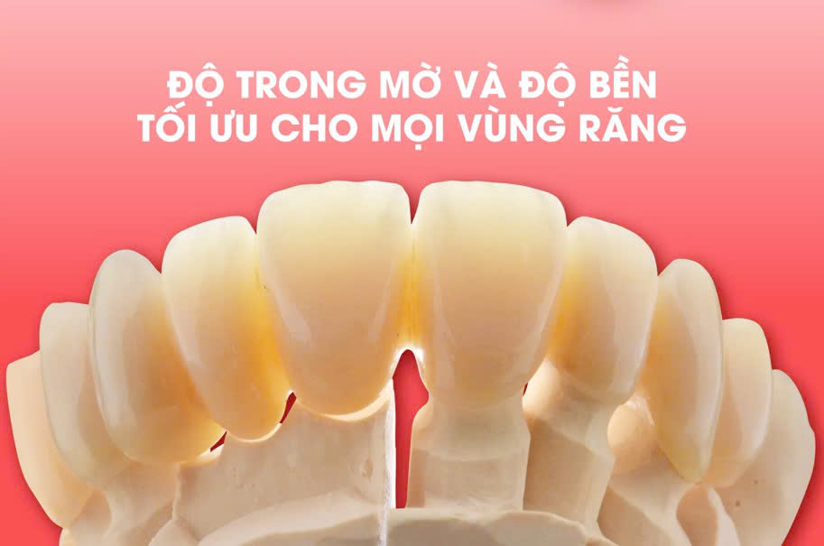Răng sứ là gì