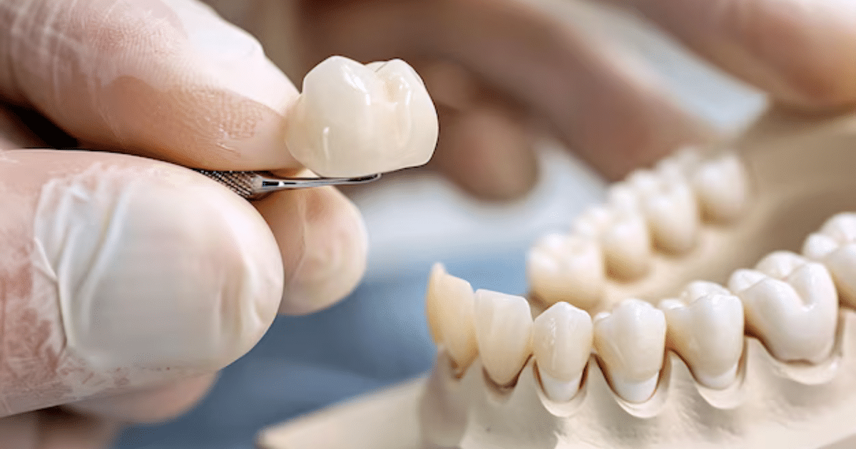 Có mấy loại răng sứ 4