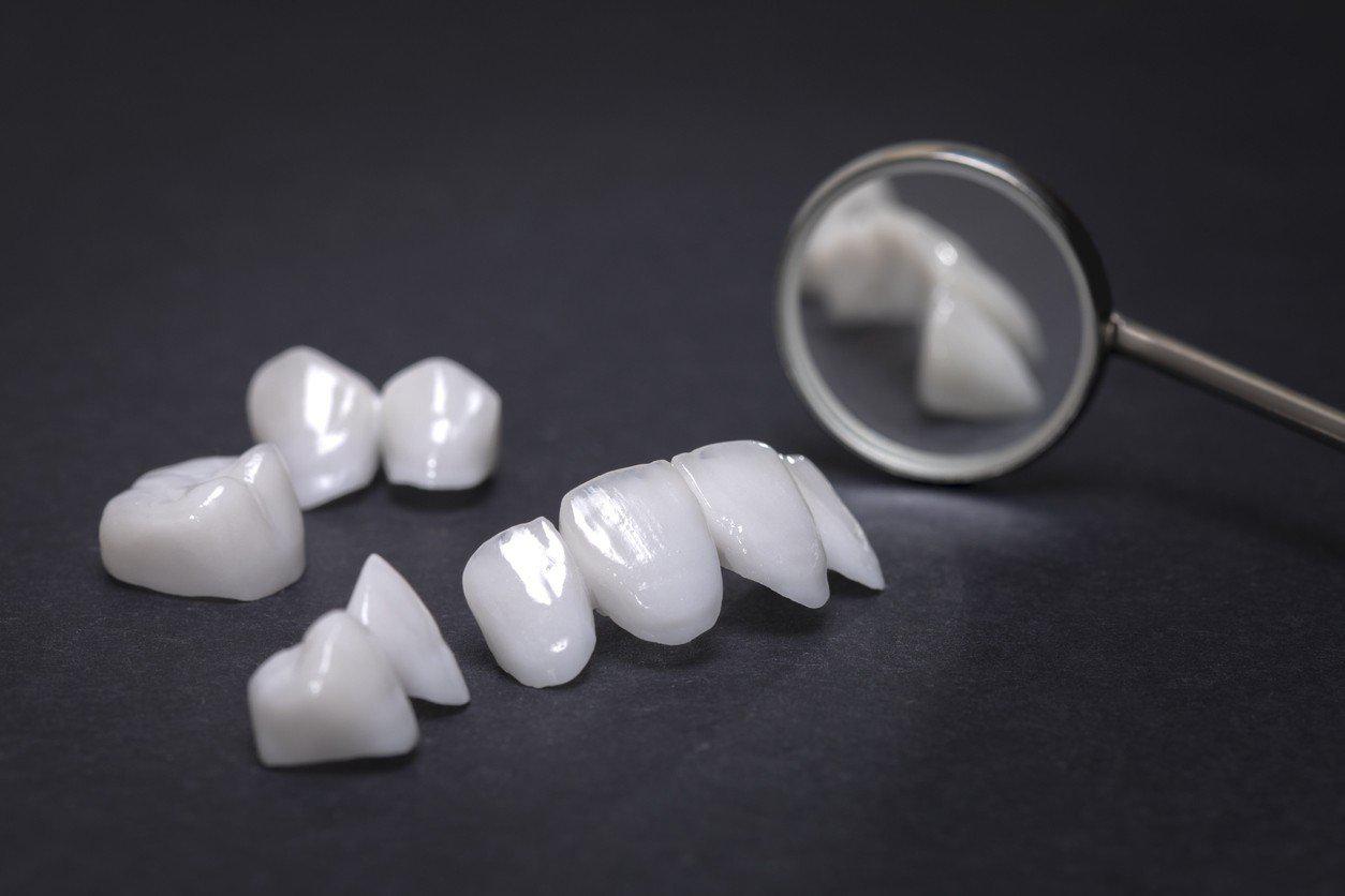 Có mấy loại răng sứ 5