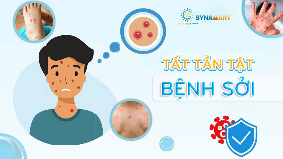 💢💢 BỆNH SỞI: NHỮNG ĐIỀU QUAN TRỌNG CẦN BIẾT 💢💢