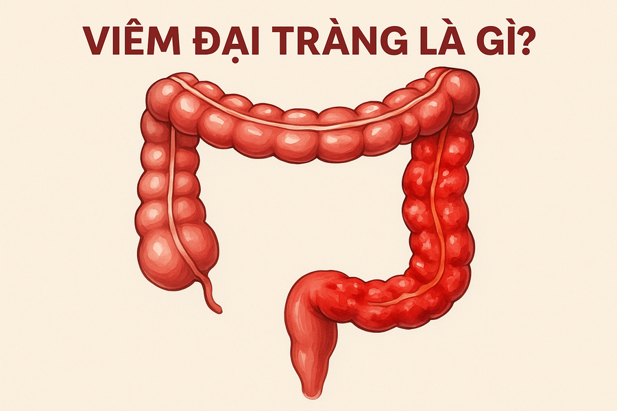 Viêm Đại Tràng: Những Điều Cần Biết Và Cách Hỗ Trợ Tự Nhiên