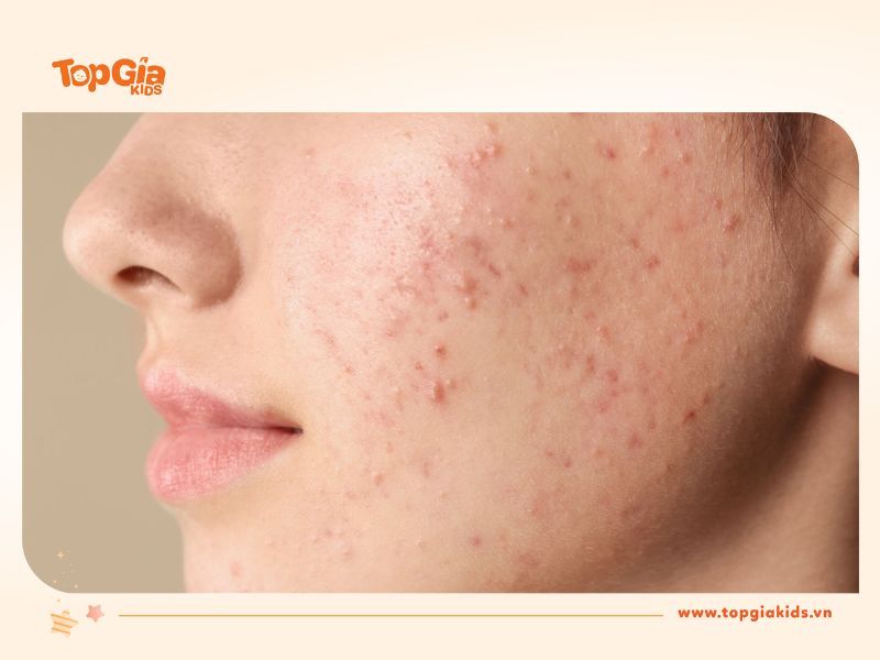 Có nên lau mặt bằng khăn ướt không