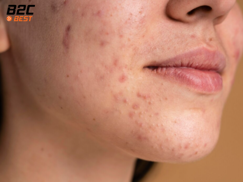 Chăm Sóc Da Nhạy Cảm Hoặc Da Mụn Đúng Cách