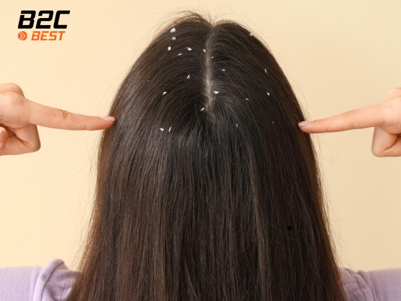 Dầu gội trị gàu hiệu quả nhất hiện nay (Review chi tiết)