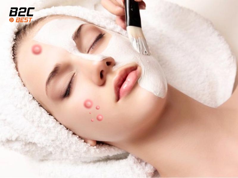 Da Mụn Có Nên Đắp Mặt Nạ Không? Giải Đáp Chi Tiết Cho Làn Da Nhạy Cảm