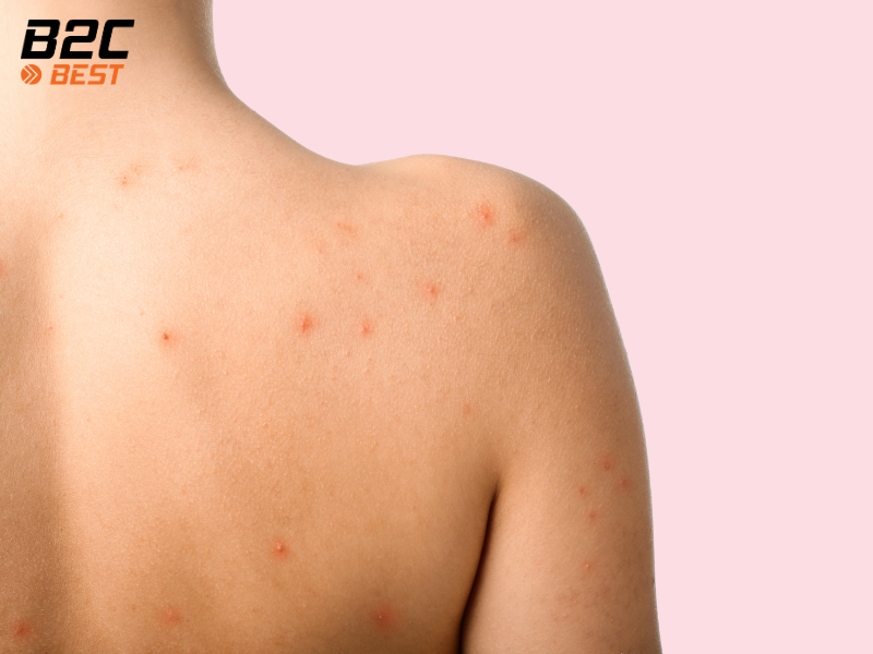 Sữa Tắm Có Thể Điều Trị Mụn Lưng Không? Hướng Dẫn Chi Tiết Và Hiệu Quả