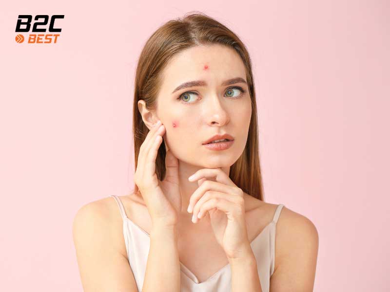 Những Thói Quen Xấu Khiến Da Mụn Ngày Càng Tệ Hơn ?