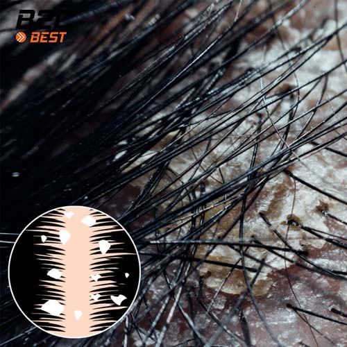 gàu là gì, tác hại của gàu