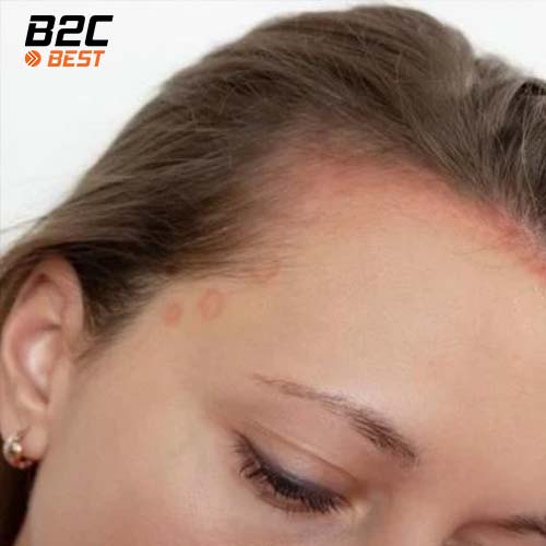 nguyên nhân gây gàu