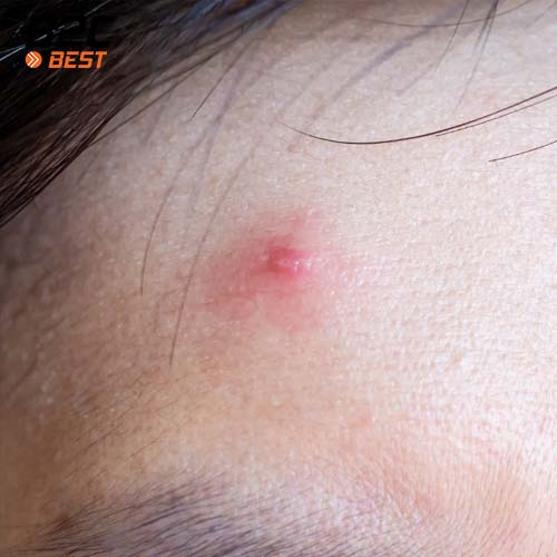 cách tẩy da chết cho da mụn đúng chuẩn-4