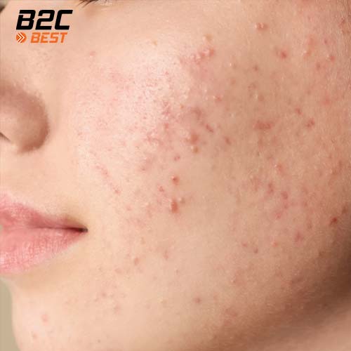 cách tẩy da chết cho da mụn đúng chuẩn-5