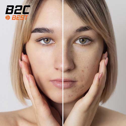 hộ trợ giảm mụn và kiểm soát dầu nhờn