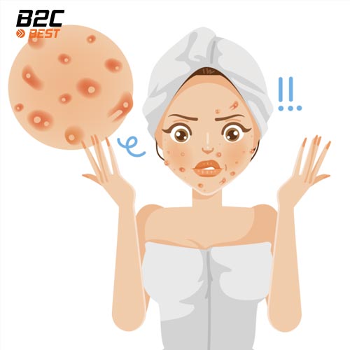 da mụn có cần đắp mặt nạ không