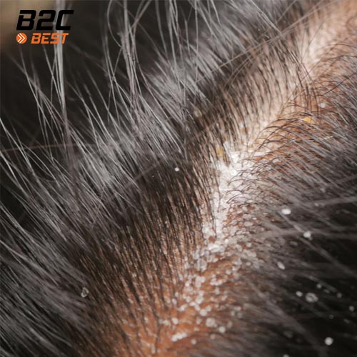 vì sao da đầu được detox định kỳ