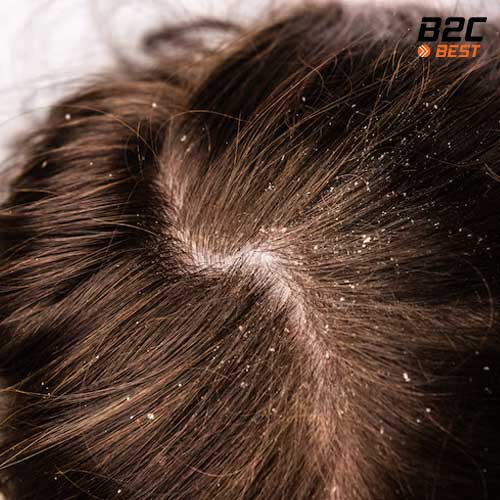 tẩy tế bào chết cho da đầu