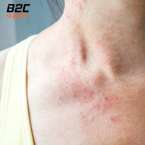 ngồi máy lạnh nhiều bị khô da và cách chăm sóc da -2