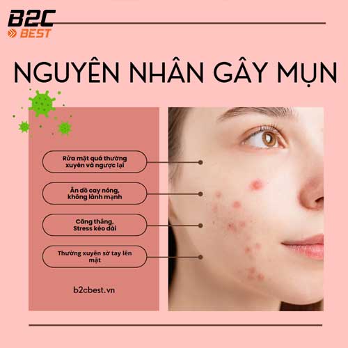 nguyên nhân gây mụn
