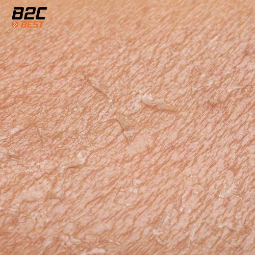 làm khô da và suy giảm hàng rao bảo vệ da