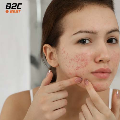 tuổi dậy thì có nên dùng mỹ phẩm không